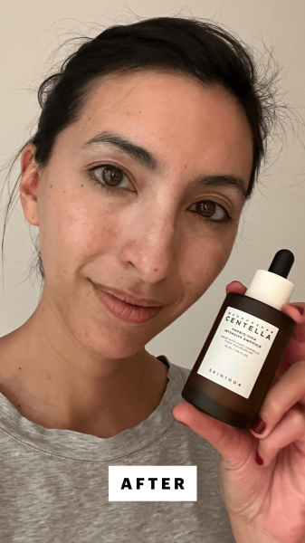 Pai after applying Skin 1004 Madagascar Centella Ampoule